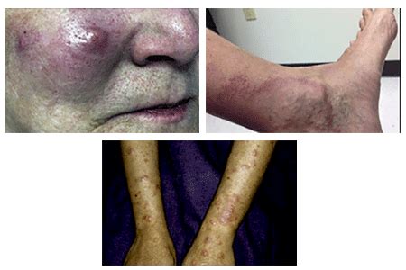 Leprosy still occurs in the United States: Are you at risk?