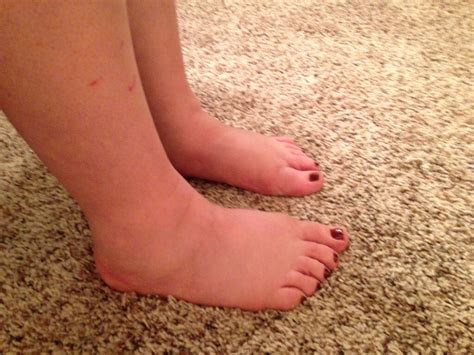 Swollen Ankles: 10 Causes of Swollen Ankles