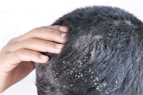 Psoriasis of the Scalp and Hair Loss | Skalptec Ltd