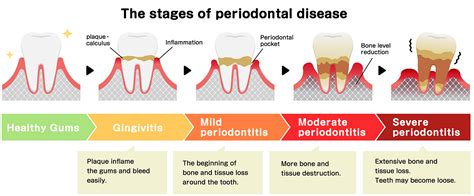 Periodontal Disease Stages