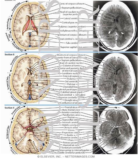 Normal Brain Anatomy as Demonstrated by Computerized Tomography (CT ...