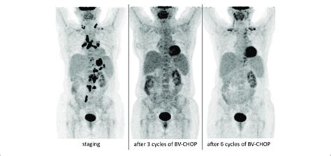 | PET/CT scan results of our patient with grey-zone lymphoma, who... | Download Scientific Diagram