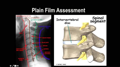 Cervical Spine X-Ray - YouTube