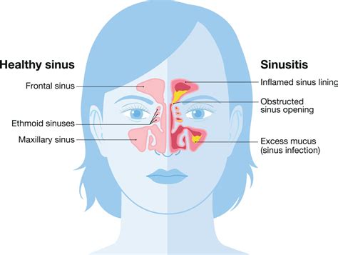 Sinus Cold Going Around 2024 - Olive Ashleigh