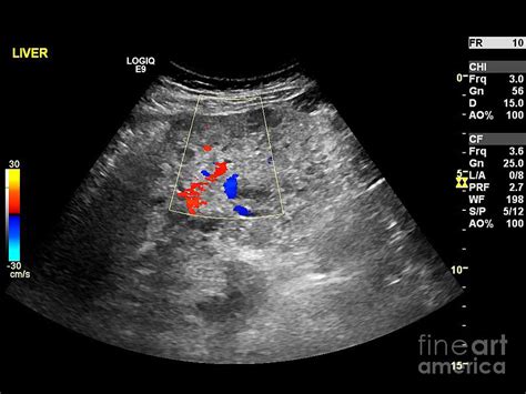 Secondary Liver Cancer, Ultrasound Scan Photograph by Science Photo Library - Pixels