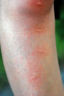 Mosquito Bite Blisters: Causes and Treatment - PestSeek