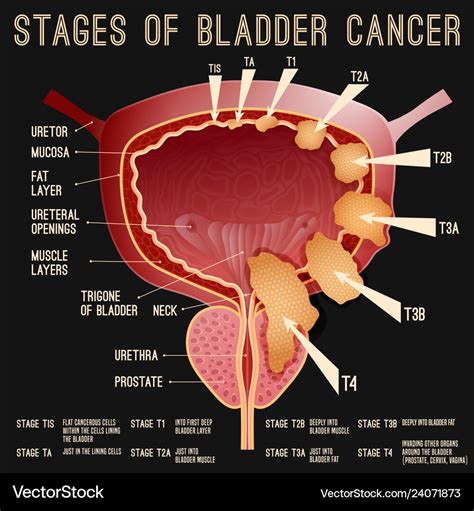 Bladder cancer stages Royalty Free Vector Image