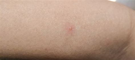 Contamination Diseases - Chicken Pox - Image of Chicken Pox Symptoms on Hand Stock Image - Image ...