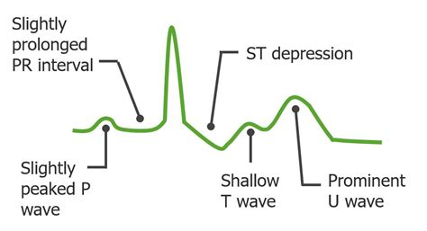 Hypokalemia Diagram