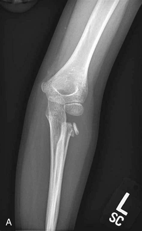 Proximal Radius Fractures in Children - Clinical Tree