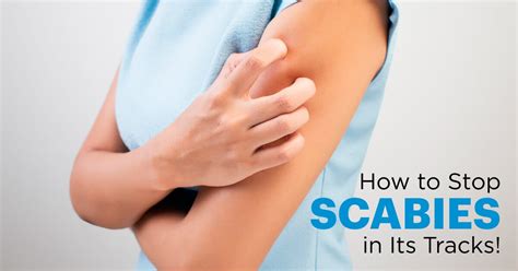 Scabies: 7 Natural Treatments That Work Fast - Dr. Axe