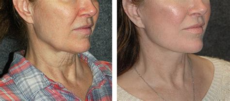 SMAS Facelift | Best SMAS Facelift Surgeon New York