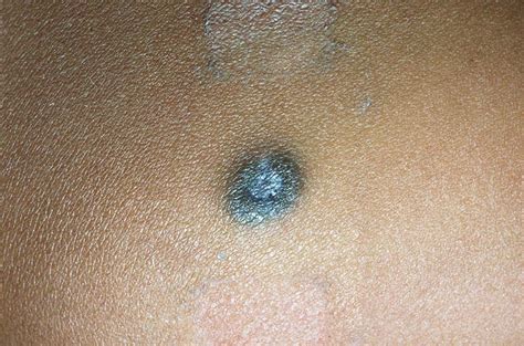 Melanocytic Nevi – Blue Nevus Overview | Perri Dermatology