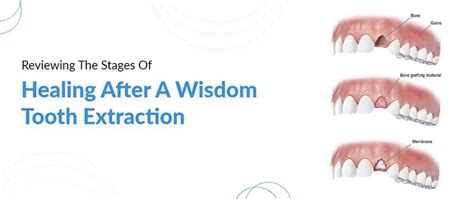 Reviewing The Stages Of Healing After A Wisdom Tooth Extraction - LA Dental Clinic
