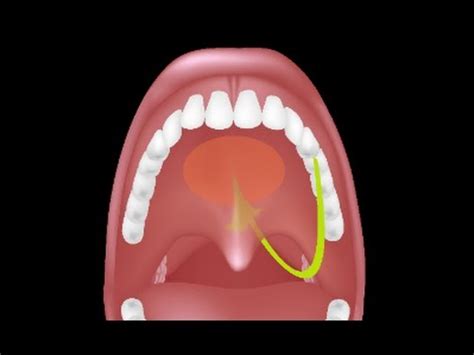 Adenoidectomy Procedure