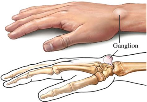 Ganglion Cyst - Causes & Management of Painful Ganglion Cysts