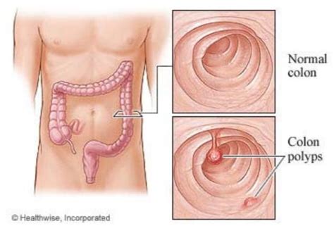 Colon Polyps: After Your Visit | South Denver GI