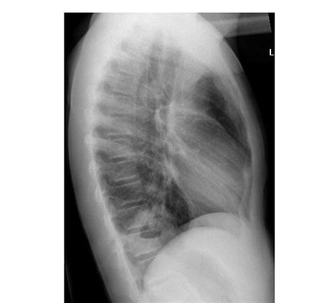 chest-x-ray-lateral-view | Emergucate