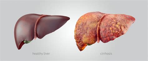 Signs Of Liver Damage That Should Not Be Ignored | Page 16 | Things Health