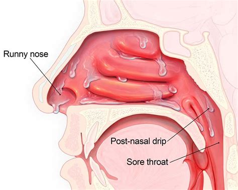 Nasal Congestion - ENT Associates