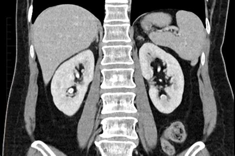 CT Scan of the Kidney | Melbourne Radiology