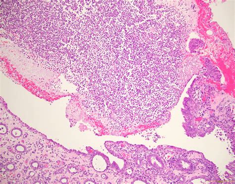 Chronic Pyelonephritis Histology