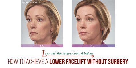 Achieve a Lower Facelift Without Surgery - The Laser and Skin Surgery Center of Indiana : Laser ...