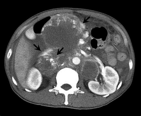 An abdominal CT scan showed hemoperitoneum from a metastatic... | Download Scientific Diagram