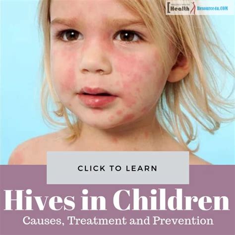 Hives In Children: Causes, Picture, Symptoms And Treatment