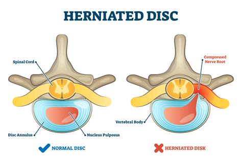 Herniated disc injury as labeled spinal pain explanation vector | The ...