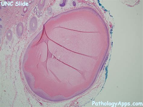 Pilar Cyst Histology