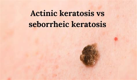 Actinic Keratosis vs Seborrheic Keratosis | Vujevich Dermatology