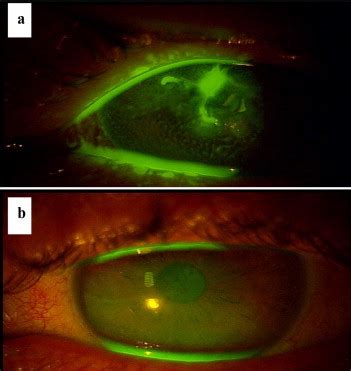 Scleral picture before and after SL insertion. Green fluorescein dye is... | Download Scientific ...