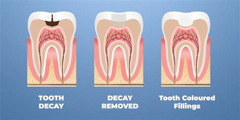 Dental Filling and Dental Restoration in Torrensville, Thebarton, Mile ...