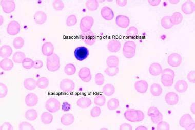 Lead Poisoning Anemia