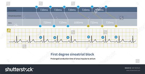 First Degree Sinoatrial Block Ecg Can Stock Illustration 1881903529 ...