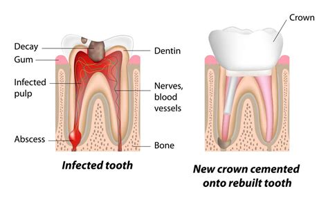 Root Canal Recovery - Lake Jackson, TX - Bell Dental