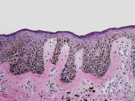 Compound Nevus Histology