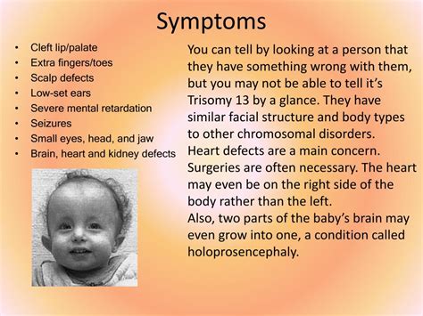 PPT - Trisomy 13 PowerPoint Presentation - ID:668954