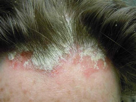 What does scalp psoriasis look like | Symptoms and pictures