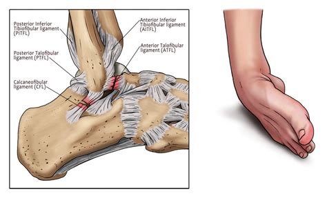 London ankle sprain - ankle sprained treatment - MyAnkle