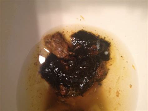 Black Stools And Diarrhea of all time The ultimate guide | stoolz