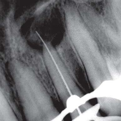 (PDF) Periapical cyst repair after nonsurgical endodontic therapy - Case report