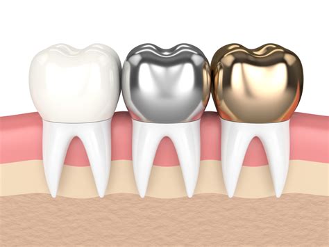 All About Dental Crown Types | Pittsburgh Dentist