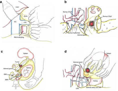 The key steps of modified RAMPS were illustrated. a Kocher’s maneuver... | Download Scientific ...