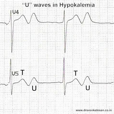 hypokalemia in ecg | Dr.S.Venkatesan MD