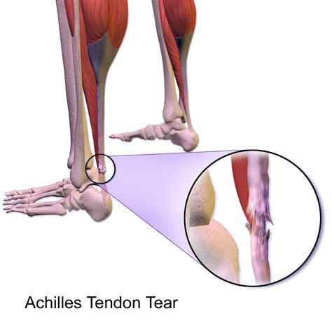 Achilles tendon rupture - Wikipedia