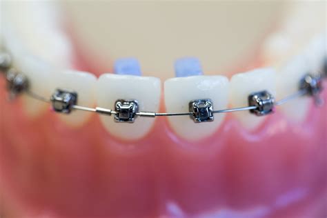 What to do if your braces have broken - Dentists in Palmers Green - Hazelwood Dental