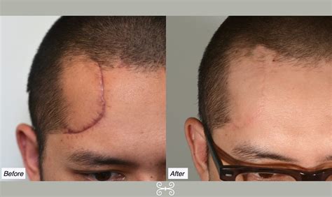 forehead scar 6months - Charleston Facial Plastic Surgery