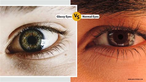 Glazed Over Eyes Causes [Quick] Ways To Treat Them